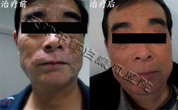 白癜風自愈方法