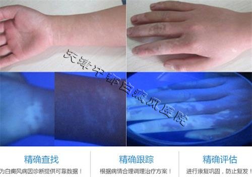 白斑和白癜風(fēng)有何區(qū)別？