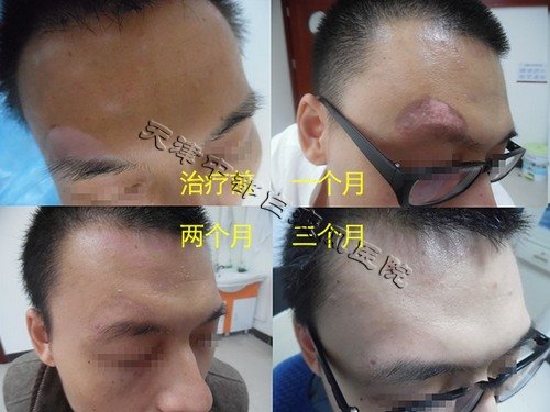 早期白癜風能治療嗎？