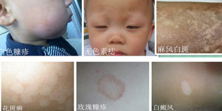 兒童白癜風癥狀有哪些呢？