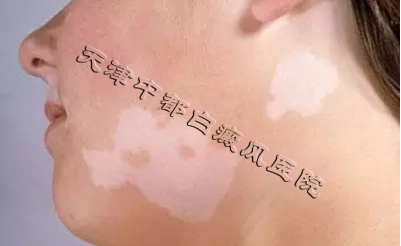 頸部有白斑怎么辦？