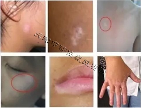 身上長(zhǎng)小白斑是白癜風(fēng)嗎？