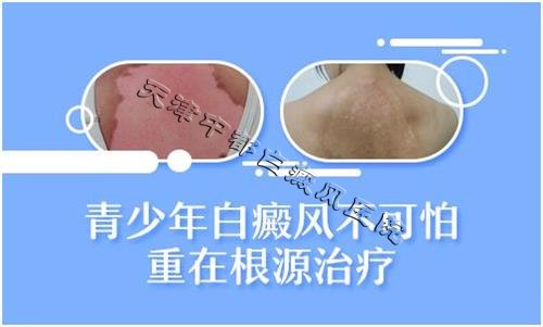 關愛兒童青少年褪白基金會公益項目走進中都