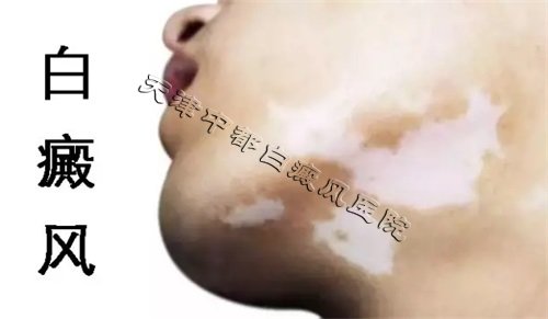 白癜風初期有什么癥狀呢？