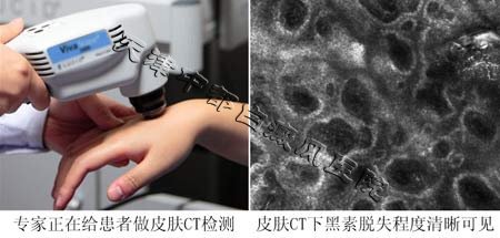 白癜風初期有什么癥狀呢？