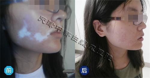 患上白癜風(fēng)能治療嗎？