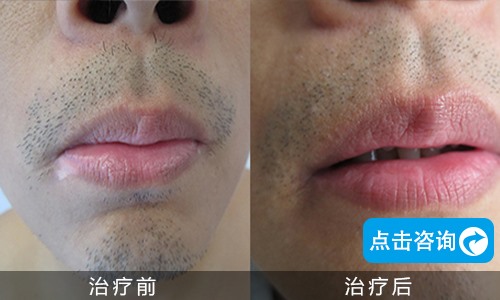 口角白癜風(fēng)